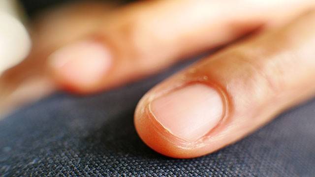 손에 있는 거스러미를 잘못 뜯으면 질환으로 이어질 수 있다｜출처: 게티이미지뱅크