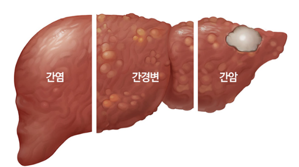 A형, B형, C형 간염 차이점, 어떻게 다를까 | 몸건강연구소