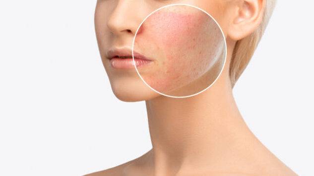 열노화는 열에 의한 피부 온도 상승에서 비롯되며, 자외선 자극보다 훨씬 더 깊은 피부 속에서 진행된다. 사진= 게티이미지뱅크