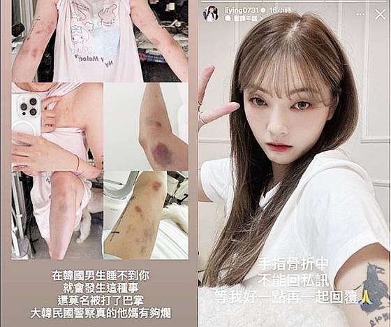 대만 인플루언서 류리잉이 자신의 소셜미디어에 올린 사진. 류리잉은 자신이 홍대에서 모르는 남성들에게 폭행당했다고 주장했다. SNS 캡처