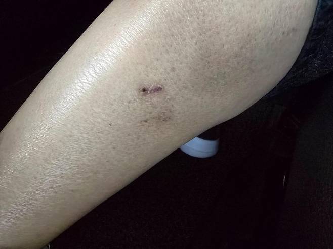 개물림 사고 한 달 후 남아있는 흉터 사진. /사진=온라인 커뮤니티 갈무리