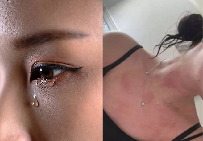 물과 닿기만 해도 피부에 심각한 발진과 화끈거림이 나타나는 이 질환은 현재까지 뚜렷한 치료법이 없어 환자들의 일상에 큰 불편을 초래한다. 좌측 사진=게티이미지뱅크/ 우측 =영국 ITV 프로그램 '오늘 아침(This Morning)'