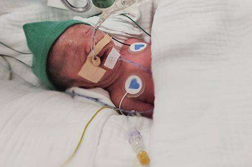 다섯쌍둥이 중 둘째 '새찬'의 출생 당시 모습. 서울성모병원