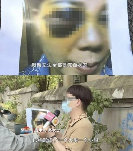 중국 창사에 사는 한 50대 여성이 눈위 지방이식 수술을 받은 뒤 눈 주변이 검붉은 빛으로 변하는 부작용을 겪었다. 자료 : 중화망