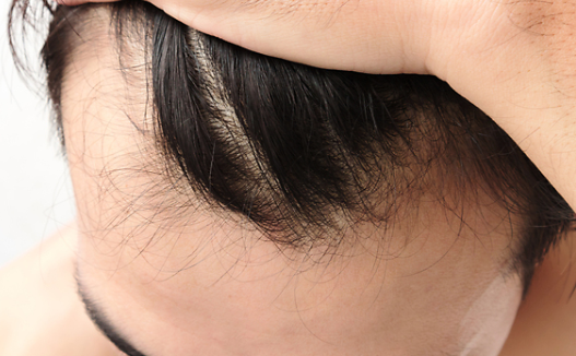 탈모 관련 이미지. 아이클릭아트