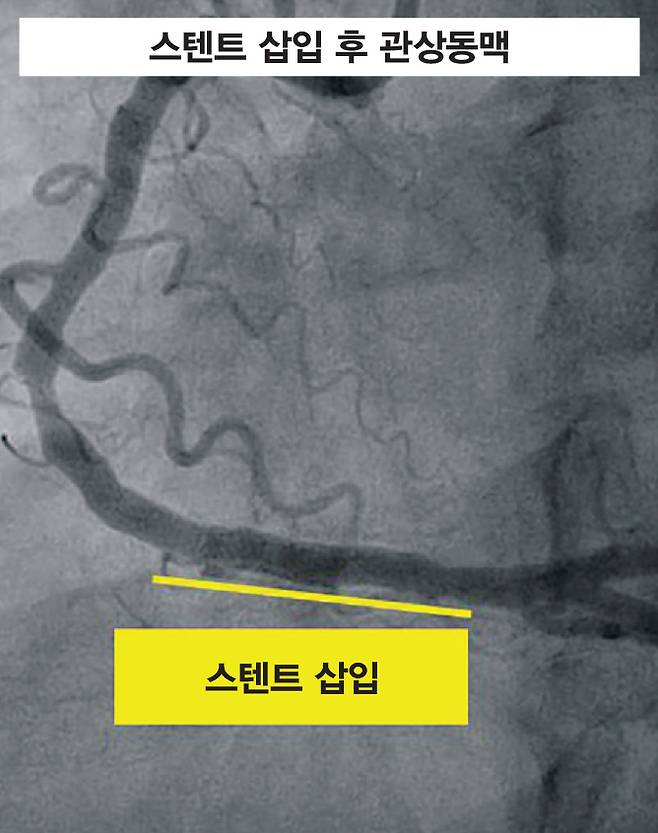 검은색으로 보이는 관상동맥에 스텐트를 삽입한 영상