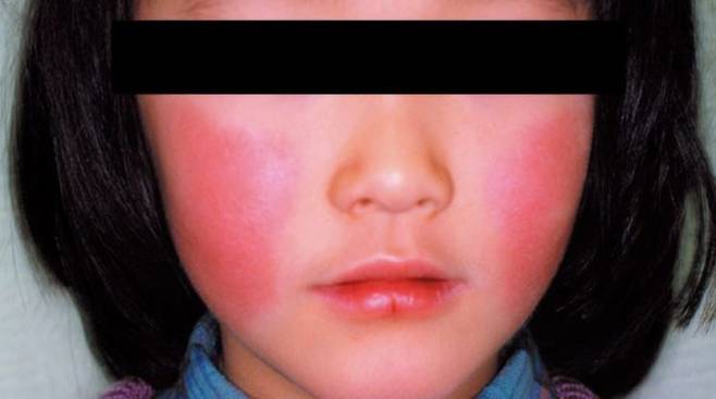 '사과병'이라고도 불리는 전염성 홍반으로 인해 양쪽 뺨에 붉은 발진이 생긴 모습. 일본 국립감염증연구소