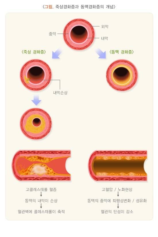 죽상·동맥경화증 개념. /질병관리청