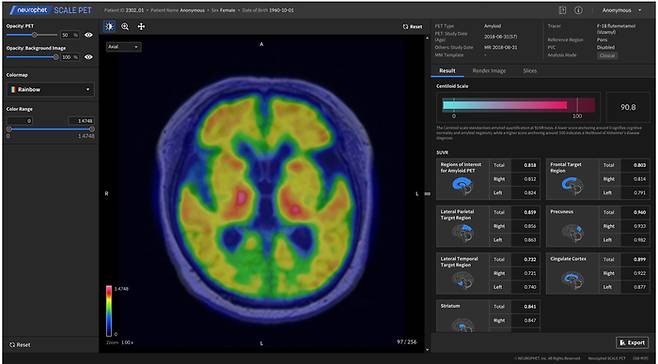뉴로핏 스케일 펫 양전자 방출 단층 촬영(PET) 영상 정량 분석 소프트웨어.