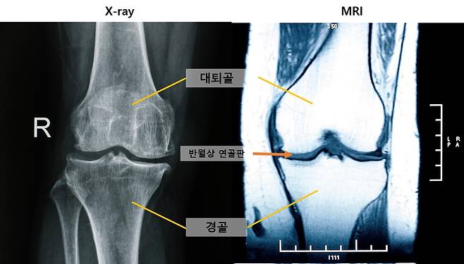 [사진 왼쪽부터] 엑스레이 및 MRI 무릎 사진