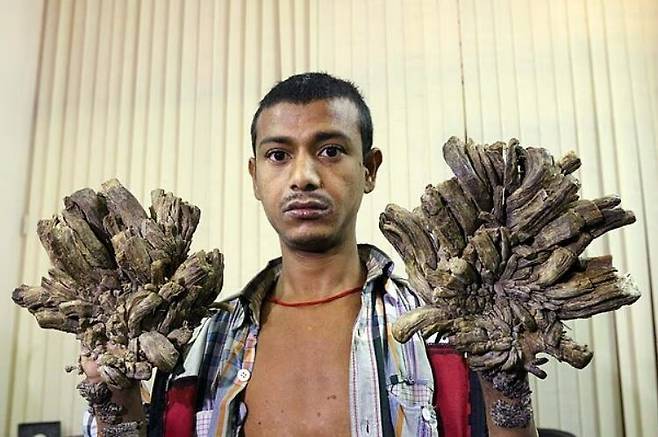 피부가 나무 껍질처럼 변하는 나무인간 증후군은 겉모습에서 오는 고통뿐 아니라, 극심한 신체적·정신적 고통까지 동반한다. 사진은 이 질환을 진단 받은 방글라데시의 아불 바잔다르. 사진=SNS