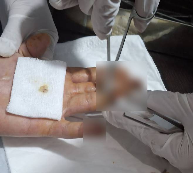 지난 7월 28일 캄보디아 시아누크빌의 범죄단지에서 탈출한 김모씨(45)가 현지 병원에서 다친 손을 치료받고 있다./사진=독자 제공