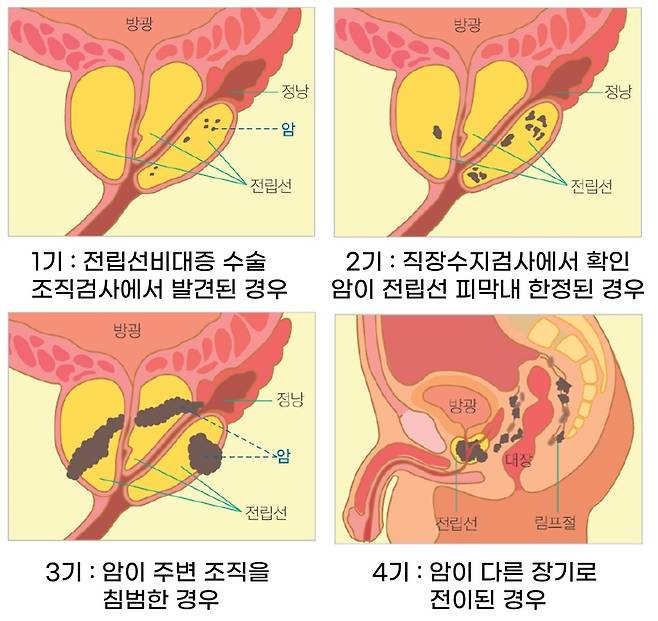 전립샘암 병기 정보. 자료 서울아산병원