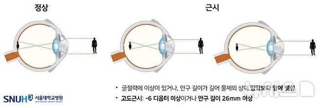 [서울=뉴시스] 근시와 고도근시. (사진= 서울대병원 제공)