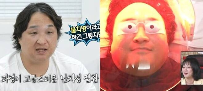 구성환이 앓는 백반증은 색소를 만드는 멜라닌 세포가 파괴돼 피부의 일부가 탈색되는 병이다. 우리나라에도 매년 6만 명 이상의 환자가 백반증으로 진료받고 있다. 사진=MBC '나 혼자 산다'