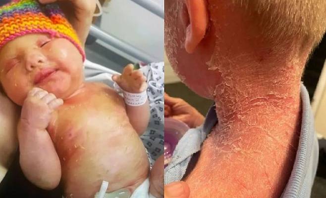 [뉴시스] 피부 전체가 비늘처럼 갈라지는 케이든의 모습. 2025.10.13. (사진=더 선 캡처). *재판매 및 DB 금지