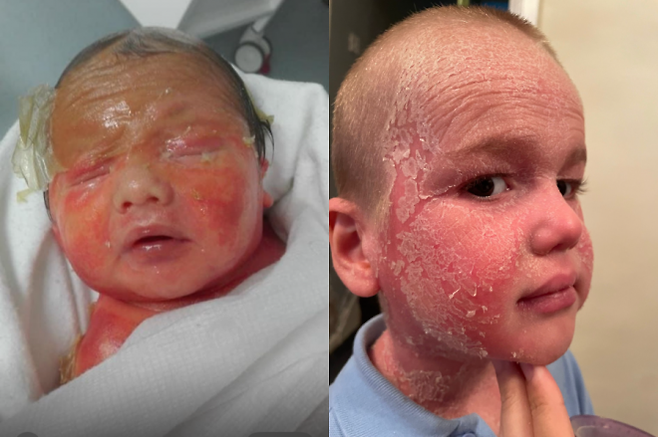 ‘선천성 비늘증(어린선)’을 앓고 있는 6살 케이든. 케이든의 엄마 리애나 벤틀리는 지난달 고펀드미를 통해 ‘나노 하이드로 버블 머신’을 구입하기 위한 모금을 시작했다. 고펀드미 캡처