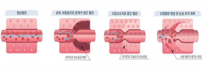 고압산소치료의 단계별 치료 원리를 설명한 그림. /자료=한림대한강성심병원