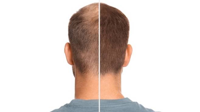 스테비오사이드가 탈모치료제 미녹시딜의 효과를 증대시킨다는 연구결과가 나왔다｜출처: 게티이미지뱅크