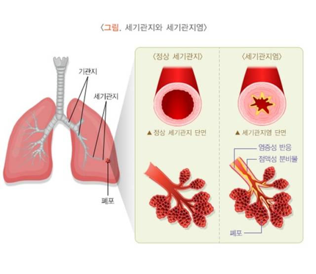 건강한 일반인(왼쪽)과 세기관지염 환자의 세기관지. 사진 제공=서울대병원
