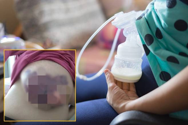 출산 후 유축기로 모유를 짜던 한 여성이 감염으로 인해 가슴 피부가 검게 썩어들어가는 충격적인 사례가 보고됐다. 배경사진=게티이미지뱅크 / 좌측 하단=멜버른 병원이 보고한 사례 PubMed Central