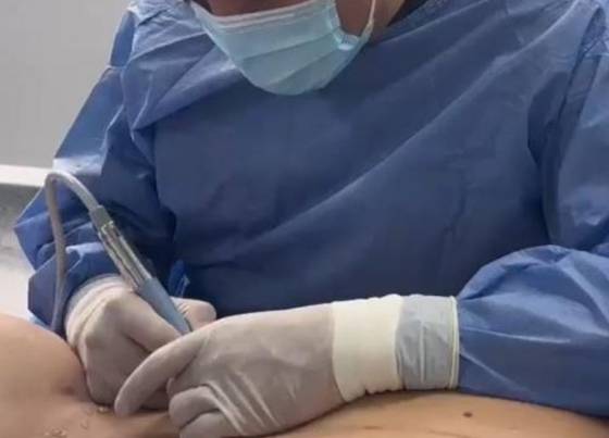 콜롬비아 보고타의 성형외과 의사인 알프레드 오요스 박사 연구팀이 개발한 'WSAP(Waistline Aesthetic Slimming by Puncture)' 허리 성형. 일명 '바비 수술'이라고 하며, 바늘을 이용해 허리에 작은 구멍을 내 진동을 일으키는 초음파 기구를 삽입해 갈비뼈를 부분적으로 변형시킨다. 바비 수술을 하고 있는 의사의 모습. 사진 오요스 박사 연구팀의 2025년 논문 '천자 및 평행 접근법을 이용한 허리선 미용 슬리밍 및 갈비뼈 재성형 절차' 캡처