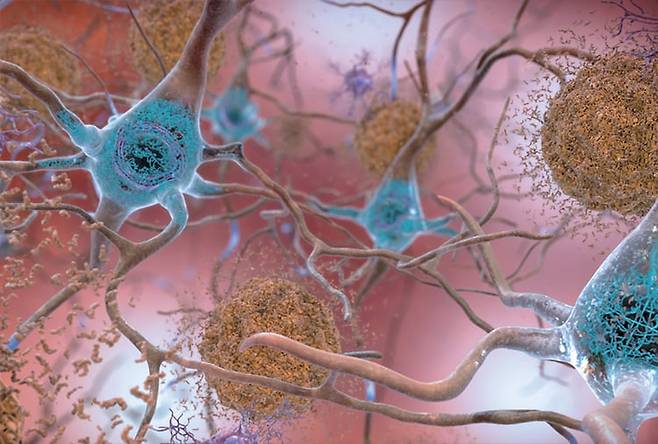 알츠하이머 치매 환자의 뇌에는 아밀로이드 베타 단백질(갈색)이 신경세포 밖에 덩어리를 이루고 있고, 타우 단백질(파란색)도 세포 안에 비정상적으로 뭉쳐 있다. /미 국립보건원(NIH)