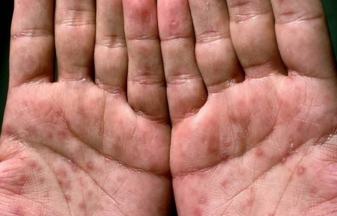 일부 인간면역결핍바이러스(HIV) 감염자에게 나타나는 피부 발진 [웹 MD]