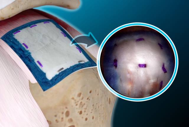 병변 부위에 리제네텐이 시술된 모습. 굳센병원 제공.