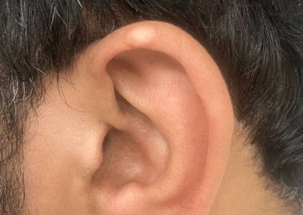 귓바퀴에 생긴 통풍 결절./사진=큐레우스