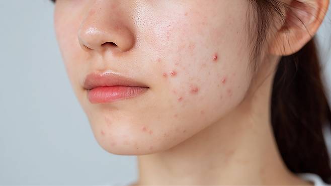 여드름 치료제는 피부를 건조하게 만들 수 있으므로 보습 관리가 중요하다｜출처: 클립아트코리아