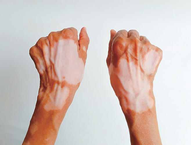 백반증에 걸린 손. /사진 셔터스톡