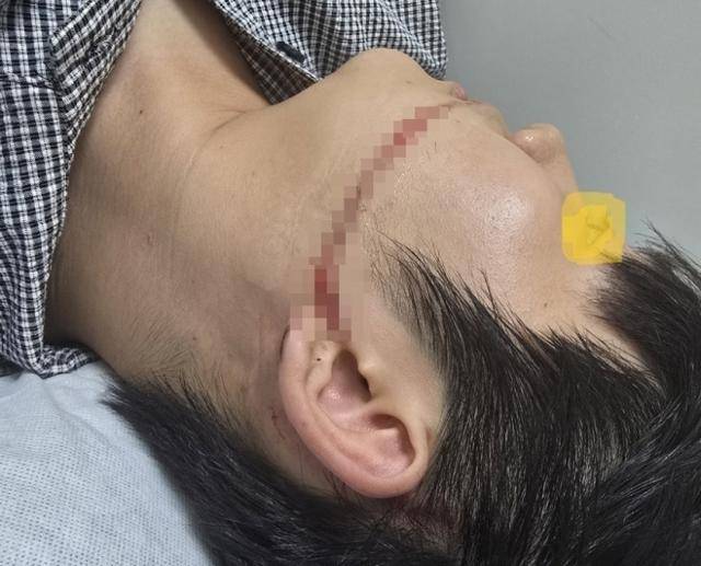 올해 8월 열린 경기 안산시 물축제에서 워터건에 맞아 다친 대학생의 얼굴에 생긴 흉터. 연합뉴스