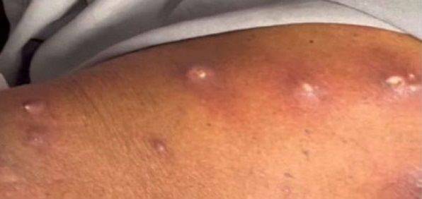 피내구더기증에 걸린 인도 남성. 사진=국제학술지(American Journal of Medical Science and Innovation), 헬스조선