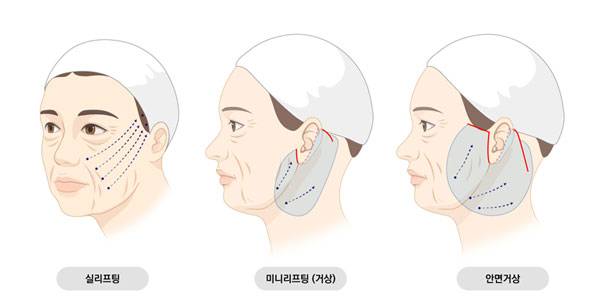 실리프팅, 미니리프팅, 안면거상의 차이./사진=스누성형외과 제공