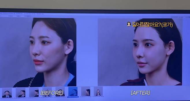 [서울=뉴시스] 티빙 '환승연애2' 출연자 이나연이 코 성형수술 전후의 모습을 공개했다. (사진=유튜브 채널 '일단이나연 NAYEON' 캡처) 2025.11.04. photo@newsis.com *재판매 및 DB 금지