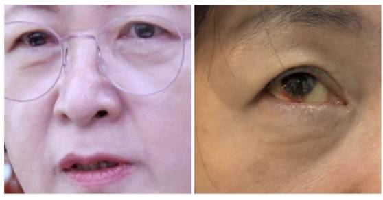 지난 3일 추미애 법제사법위원장이 페이스북을 통해 ″법사위 왼쪽 줄의 고성과 고함 지르기″라며 충혈된 눈 사진을 공개했다. 페이스북 캡처