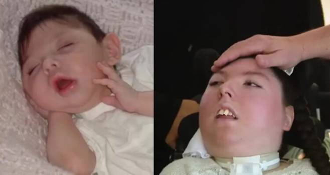 미국 네브래스카주 오마하에 사는 알렉스 심슨은 태어날 때부터 뇌가 거의 없는 '수두증성 무뇌증(hydranencephaly)'을 안고 세상에 나왔다. 사진=유튜브 WHAS11