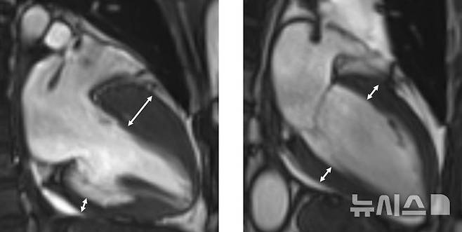 [서울=뉴시스] 왼쪽부터 비후성 심근병증을 가진 환자의 자기공명영상, 정상 심장 자기공명영상. (사진= 고려대학교 안산병원 제공)