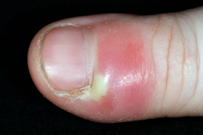 손발톱주위염 실제 병변. /사진=클립아트코리아