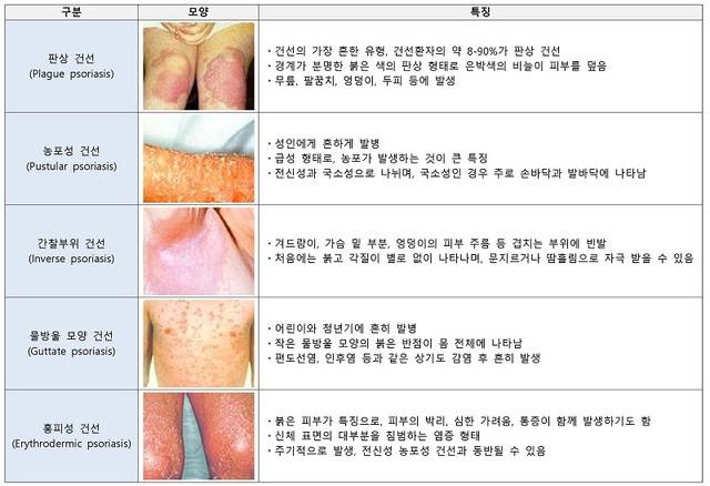 건선의 임상형태별 분류. 대한건선학회