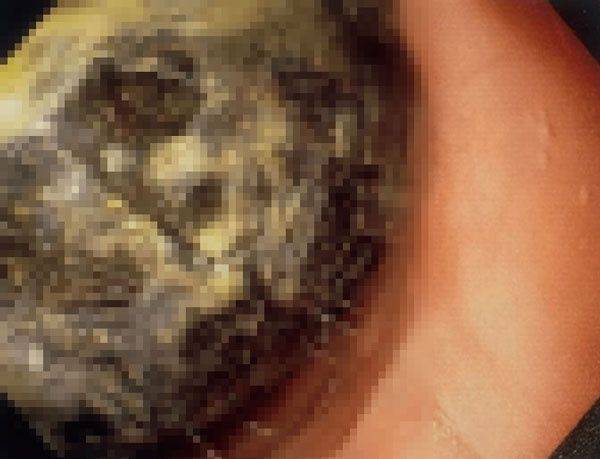 수개월 동안 복통과 구토를 지속적으로 해온 20대 여성의 복부에서 머리카락 덩어리가 발견된 사례가 보고됐다./사진=큐레우스