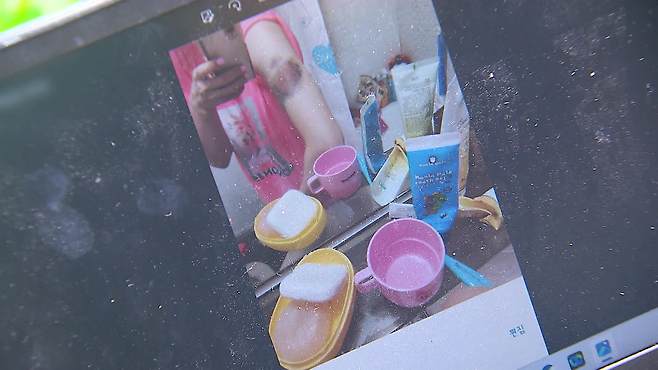 폭행당해 멍든 이은총 씨의 팔 사진