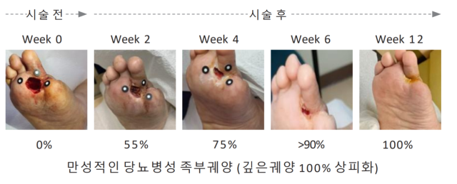 로킷헬스케어의 당뇨발 패치 시술 과정. 사진 제공=로킷헬스케어