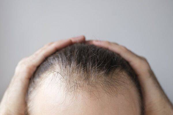 겨울철에 다른 사람과 모자를 함께 썼다간 두피 백선에 감염될 수 있다는 경고가 나왔다. 게티이미지뱅크