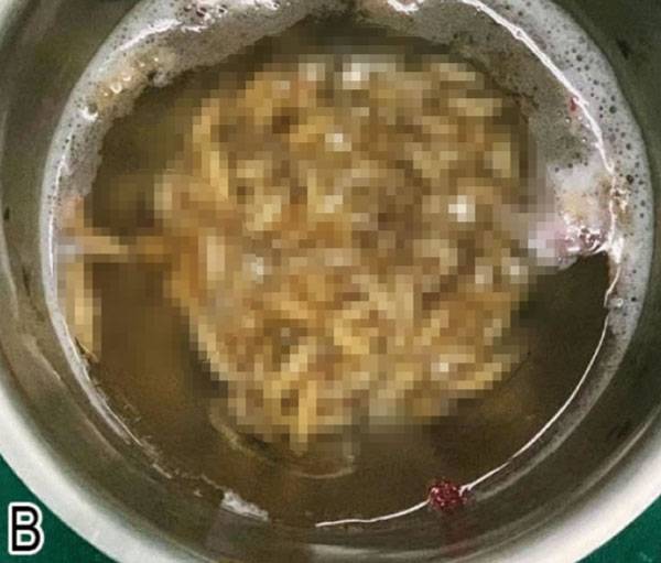 오른쪽 코에 구더기증이 발생한 50대 태국 여성의 사연이 공개됐다. /사진= ‘의학 사례 보고 저널’
