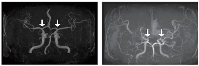 [사진 왼쪽부터] 정상 및 모야모야병 환자의 뇌혈관