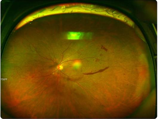 당뇨망막병증에서 발생한 유리체 출혈과 망막 출혈. /자료=국민건강정보포털