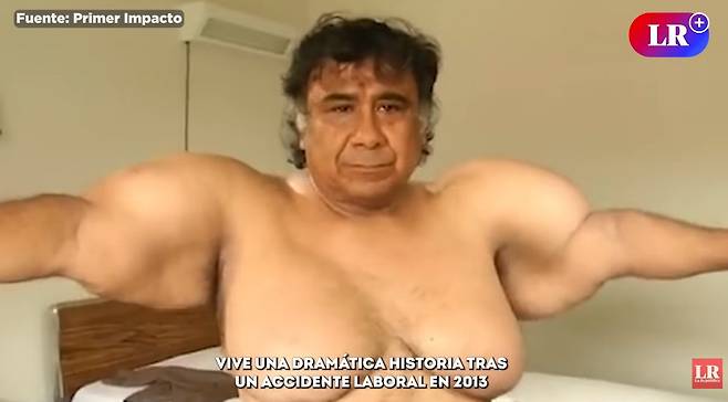 잠수 사고 이후 몸이 풍선처럼 부푼 채 살아온 페루 남성 [라 레푸블리카 제공]