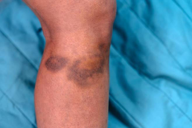 피부의 콜라겐 층이 얇은 눈가나 정강이 등에서 특히 멍이 잘 생긴다. 사진= 게티이미지뱅크